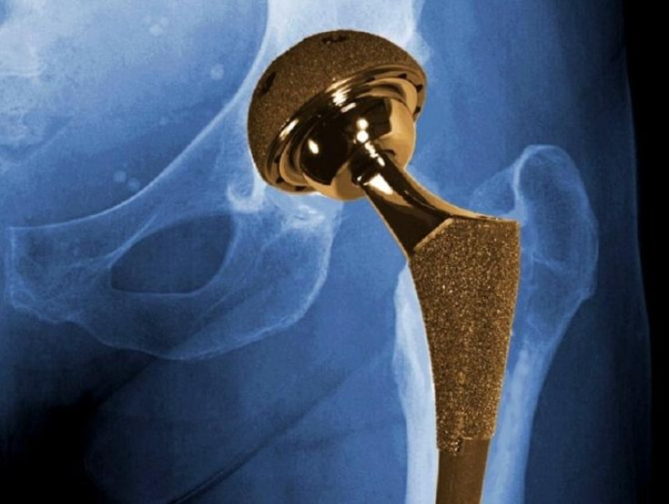 X-ray of the hip region with a metal-on-metal implant.