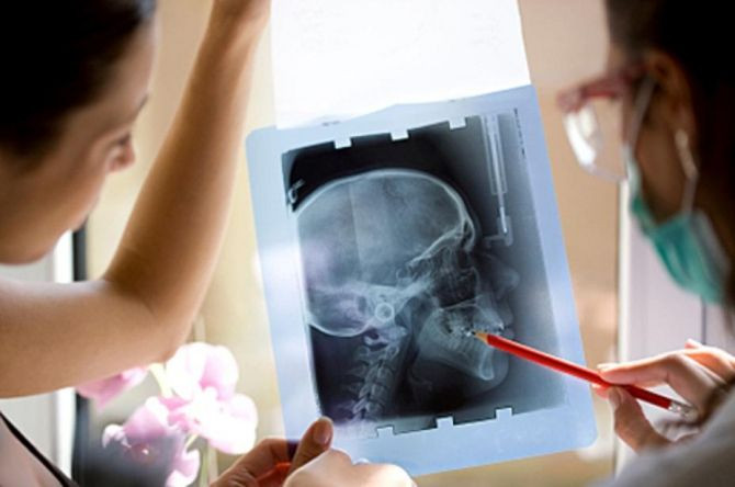 People who have had a history of frequent dental x-rays, particularly at a young age, have an increased risk of developing meningioma, the most common type of brain tumor in the United States.