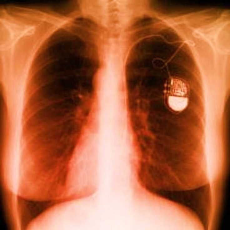 An x-ray of the chest showing a pacemaker.