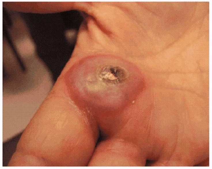 The figure above shows a bulla caused by orf virus infection after puncture by a bone of a recently slaughtered goat in Greece in 2009. Two weeks later, the woman whose hand was infected traveled to Pennsylvania to visit her son. By that time, a large bul
