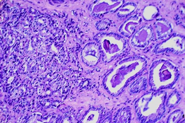 prostate cancer