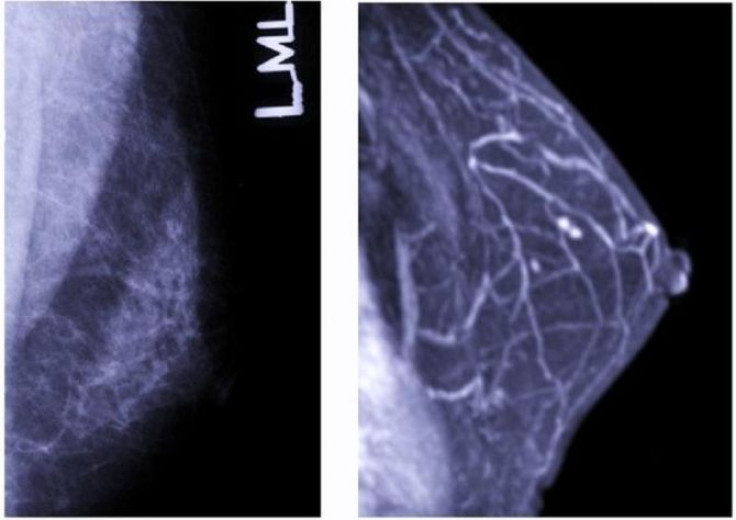 Computational Biology hopes to help in breast cancer treatment