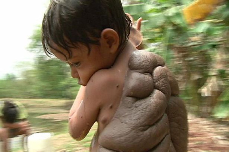 6-year-old Didier Montalvo's giant mole on his back, which gave him the nickname 'Turtle Boy', was recently removed by UK plastic surgeon Neil Bustrode.