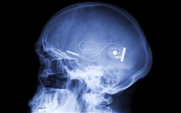 X-ray of the skull showing the implant, which mimics the natural way the eye processes light and sends messages to the brain, restoring &quot;useful vision” in the eyes of blind patients.