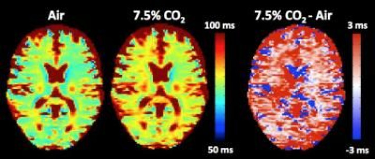 brain acidity