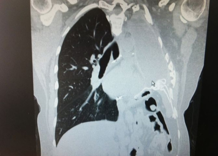 lung cancer CT scan