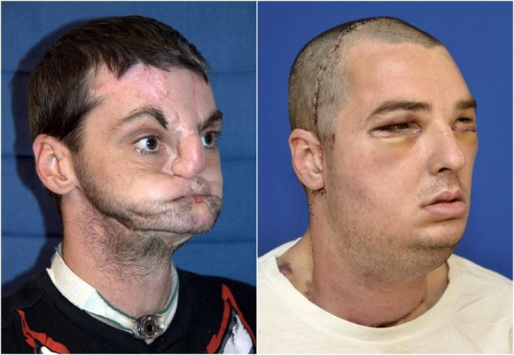 Richard Norris, face transplant