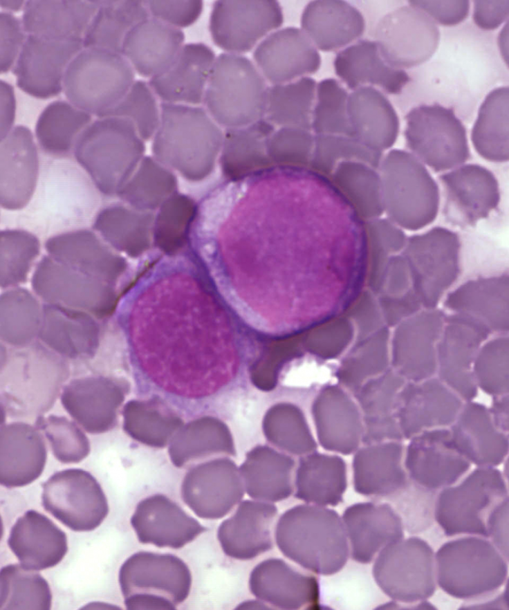 Leukemia cells