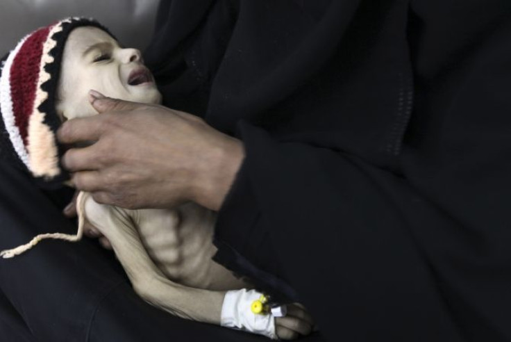 Woman holds her malnourished child at a therapeutic feeding center at al-Sabyeen hospital in Sanaa.