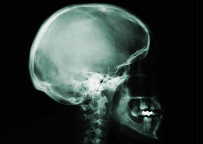skull