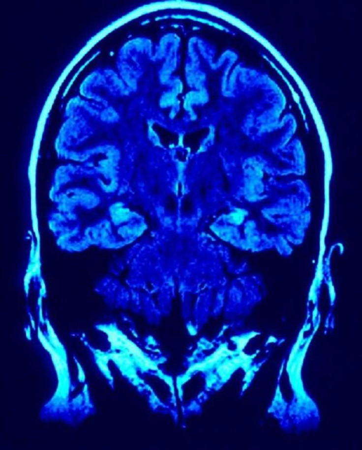 brain scan, right and left hemisphere