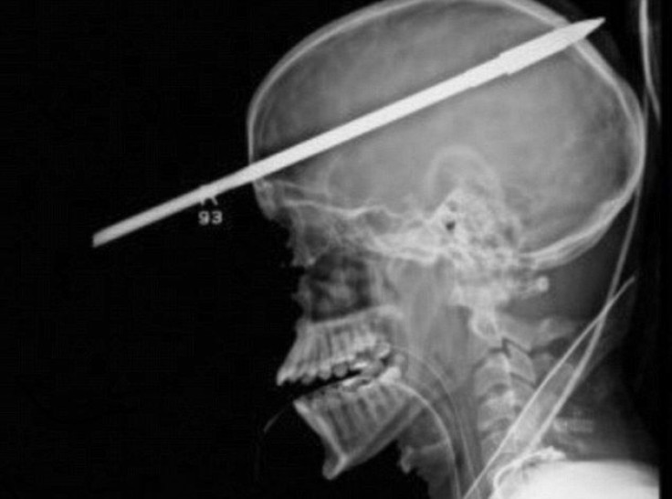 An X-ray shows a fishing spear lodged in the skull and brain of Yasser Lopez, 16, who was shot when his friend accidentally shot a spear gun.
