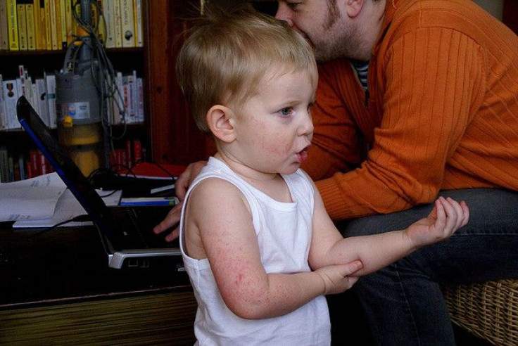 Child with Eczema