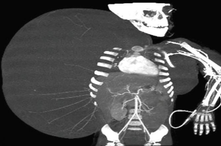 In this still image taken from an undated video released by the Mexican Social Security Institute (IMSS) on Tuesday, June 26, 2012, an image created through medical imaging technology shows an X-ray-like image of 2-year-old Jesus Rodriguez, prior to havin