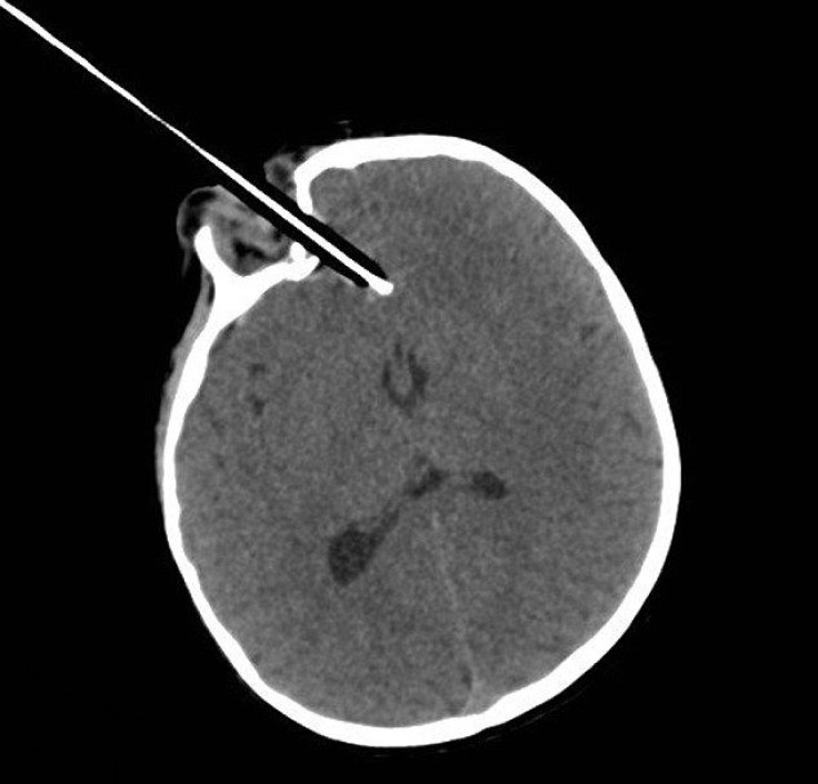 An X-ray scan that shows the pencil lodged in Wren's brain after she tripped and fell on to it.