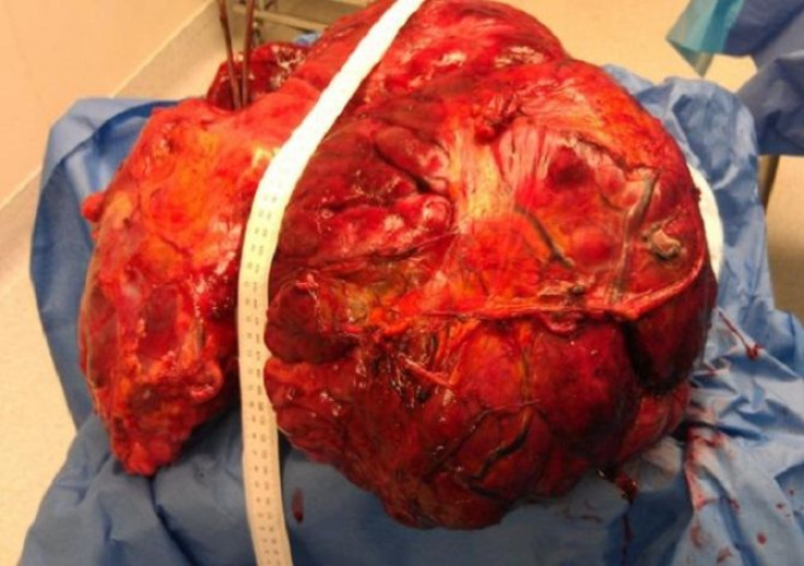 Doctors at Riverview Medical Center in New Jersey removed a 51-pound cancerous tumor from a 120 woman who arrived at the hospital with stomach pains.