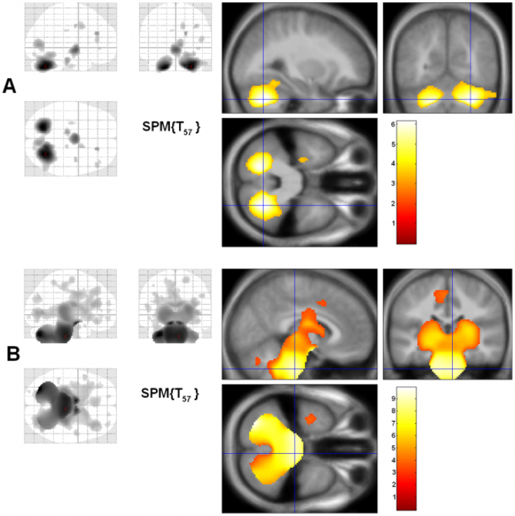 wolfram syndrome