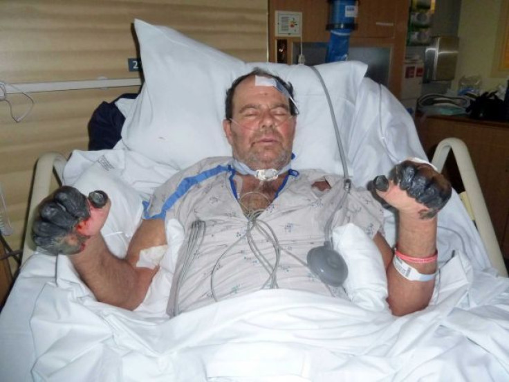 This photo was given by the Gaylord family was taken July 6, 2012, at a hospital in Bend, Ore., and shows Paul Gaylord as he recovers from the plague.
