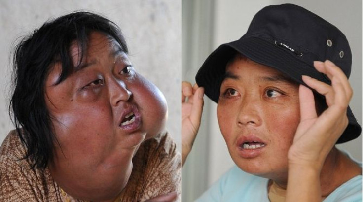 Li Hongfang, whose face in the left picture was severely disfigured by 7 large tumors, is transformed in the picture on the right after a hospital carried out the surgery for free.