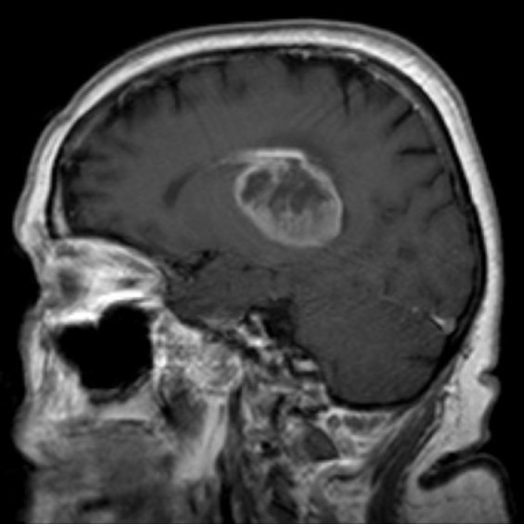 glioblastoma