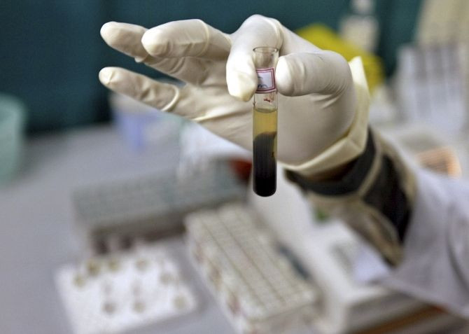 Hepatitis test