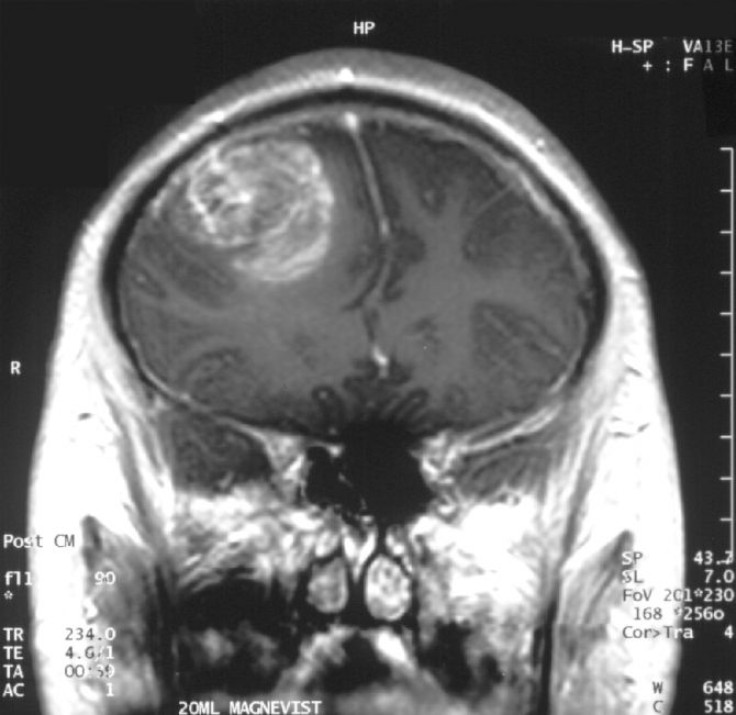 glioblastoma