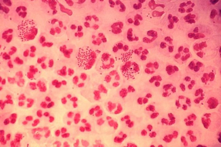 Gonorrhea May Become &quot;Untreatable&quot;