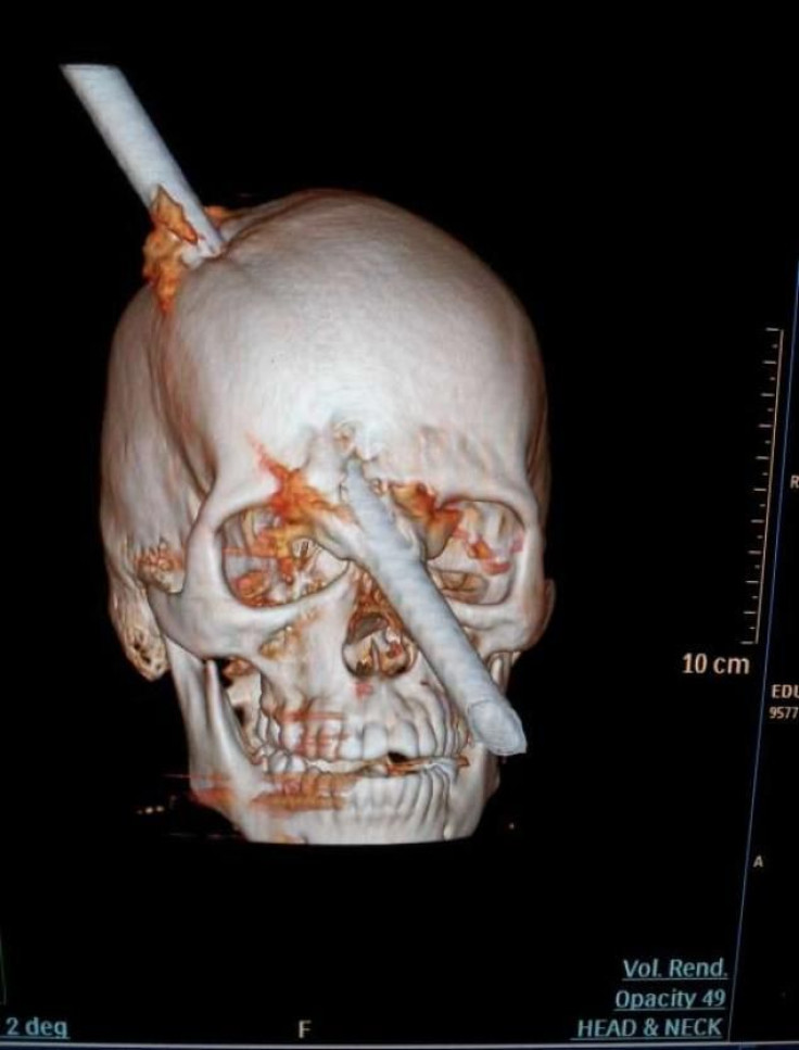 This tomography scan released Thursday, Aug. 16, 2012 by the Miguel Couto hospital, shows the skull of 24-year-old Eduardo Leite pierced by a metal bar in Rio de Janeiro.