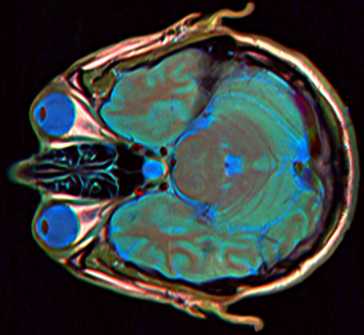 MRI of the Brain