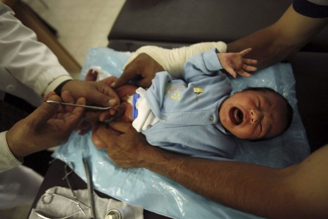 Falling Circumcision Rates In Us Raise Disease Risk And Healthcare Costs 9994