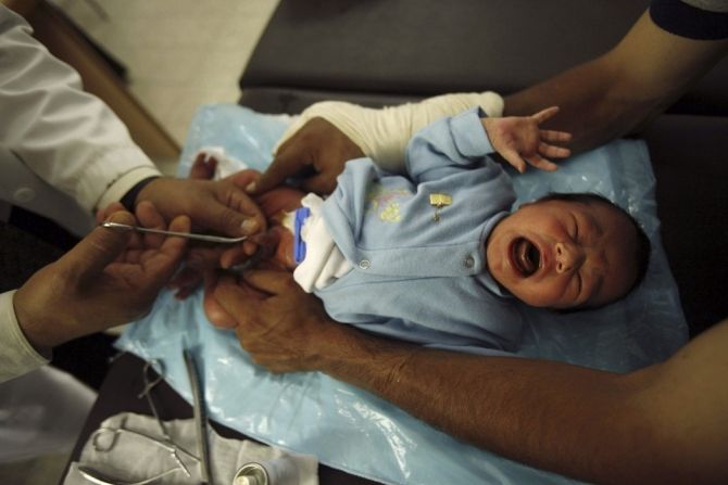 Falling Circumcision Rates in US Raise Disease Risk and Healthcare Costs