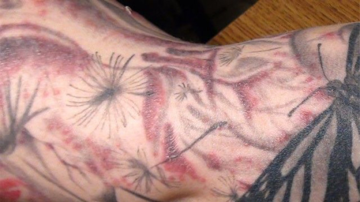 Tattoo infection