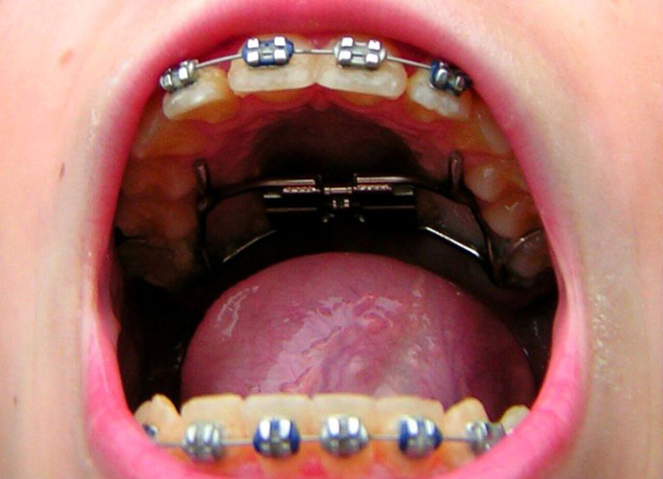 braces