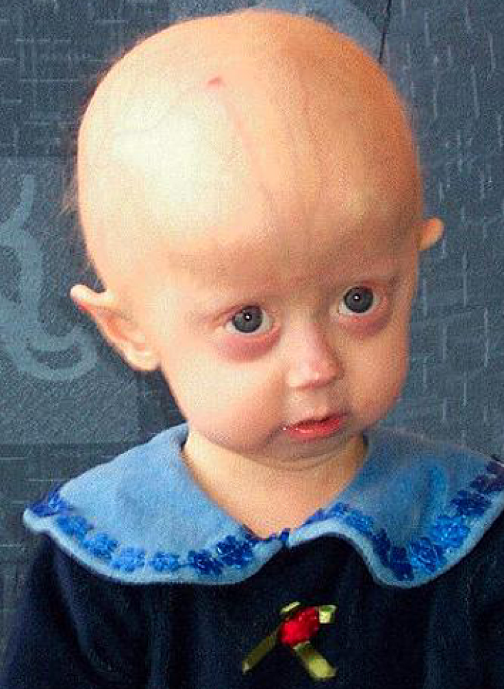 Progeria