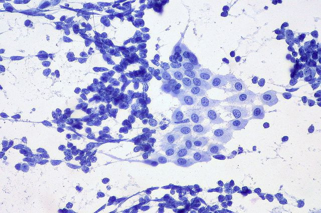 Lung cancer