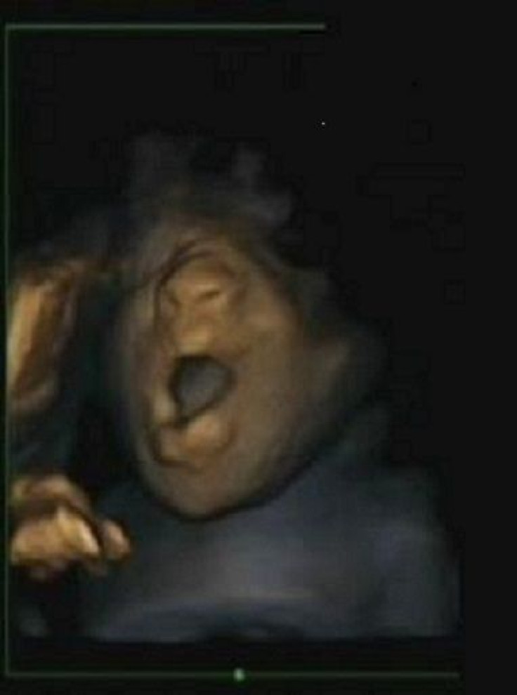 Fetus Yawning
