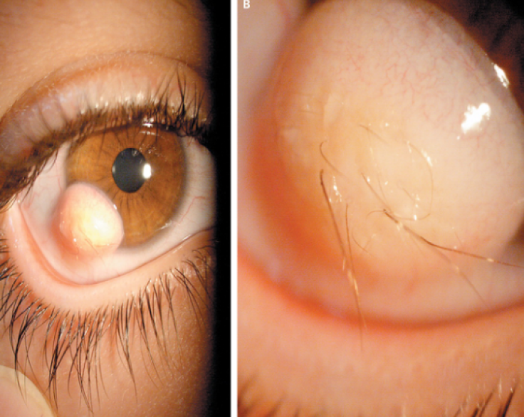 limbal dermoid tumor