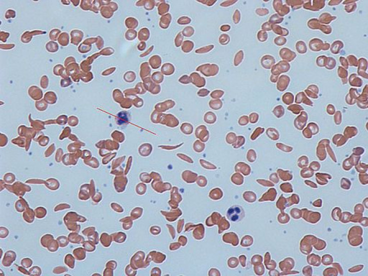 sickle cell