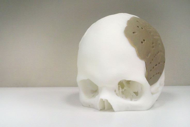 OsteoFab Patient Specific Cranial Device (OPSCD)