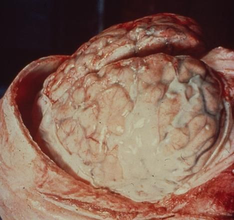 Meningitis Outbreak Hits New York City