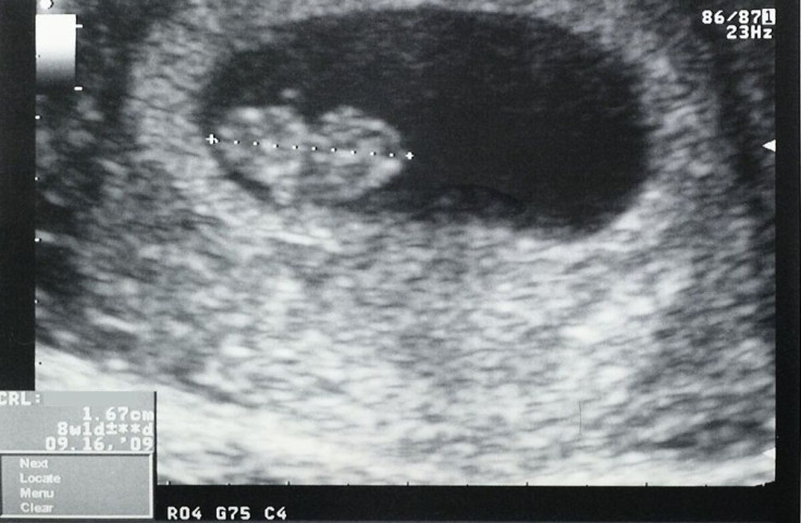Ultrasound Fetus