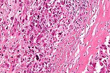 Osteosercoma