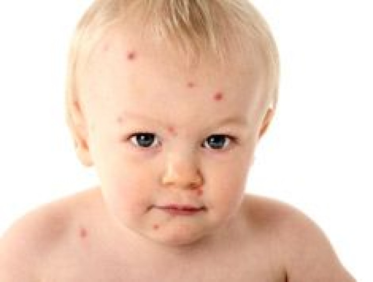 Chicken Pox Now Rare, Thanks To Vaccine