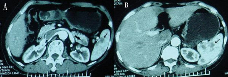 Radioactive Listeria Delivers Therapy To Kill Cancer