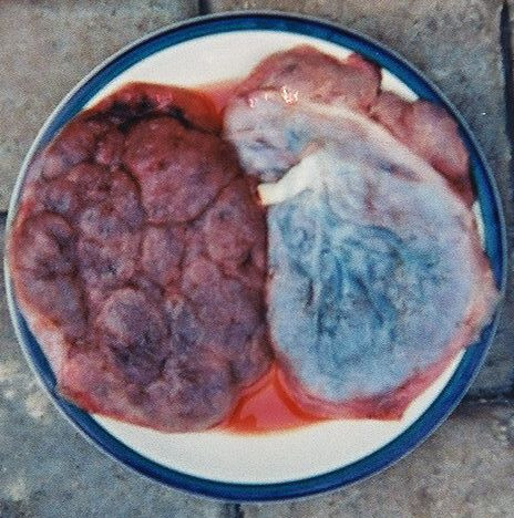 Placenta