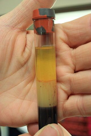 Blood Vial HIV/AIDS test
