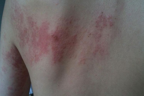 Shingles, a viral infection that causes a painful rash, primarily affects the elderly.