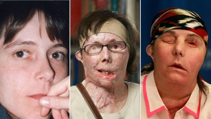 Face transplant