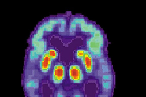 A positron emission tomography (PET) scan of a brain with Alzheimer's disease.