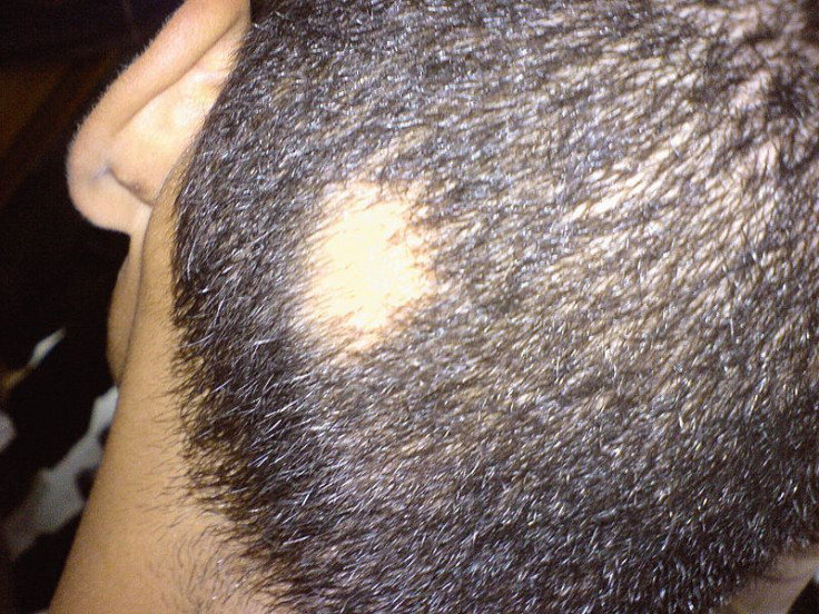 Alopecia